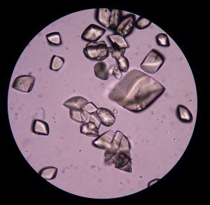 Uric acid in urine sediment.